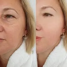 Bioestimulación de colágeno: una conversación abierta sobre el presente y el futuro de la medicina estética